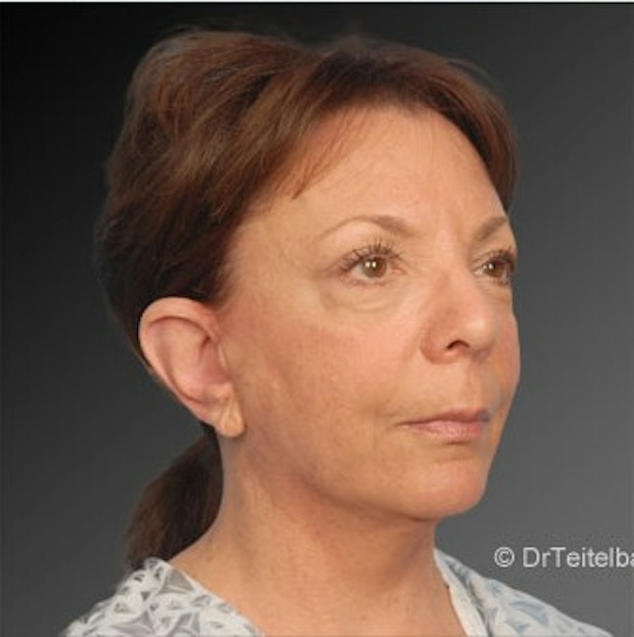 Patient 106009215 | Angle View | After | Face and Neck Lift — Steven Teitelbaum MD -
