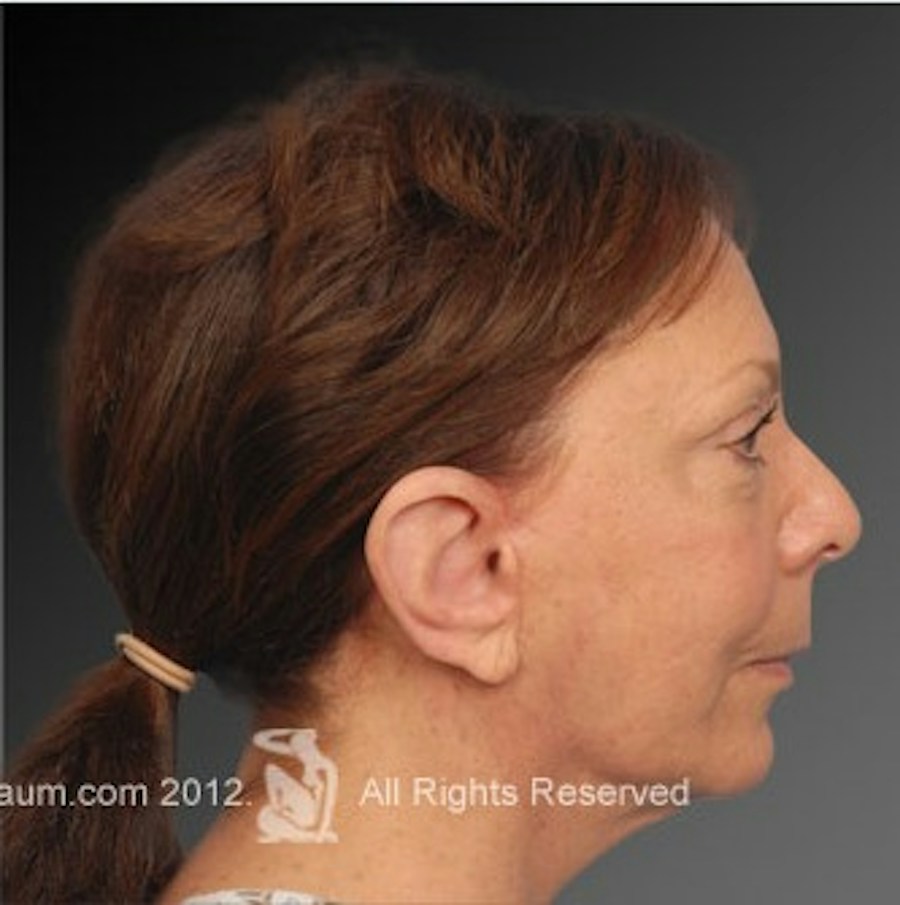 Patient 106009215 | Profile View | After | Face and Neck Lift — Steven Teitelbaum MD -