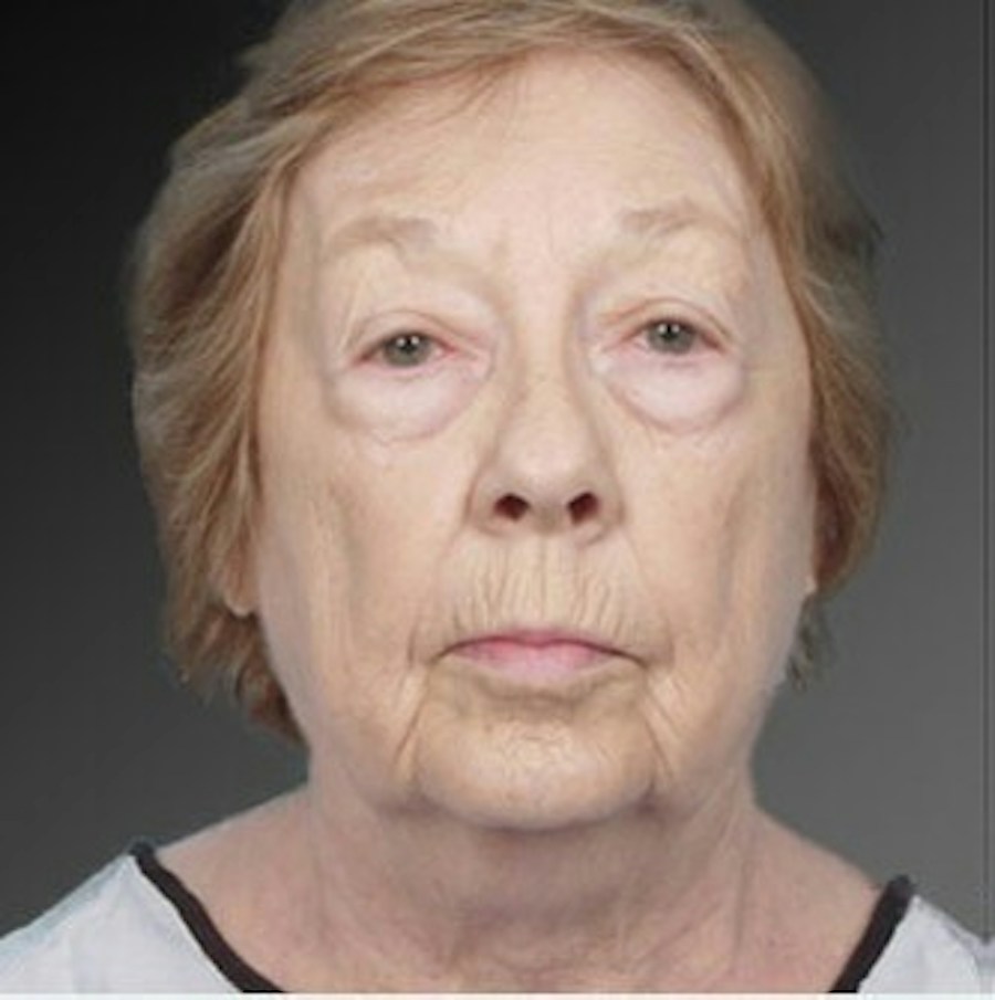 Patient 106009216 | Front View | Before | Face and Neck Lift — Steven Teitelbaum MD -