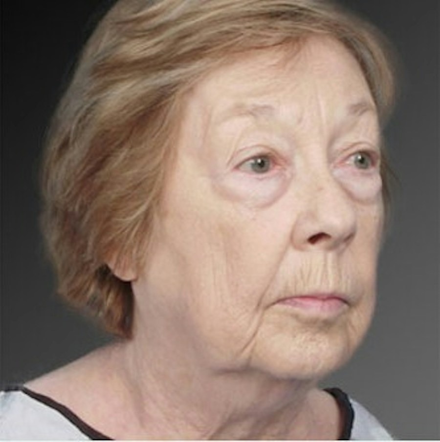 Patient 106009216 | Angle View | Before | Face and Neck Lift — Steven Teitelbaum MD -