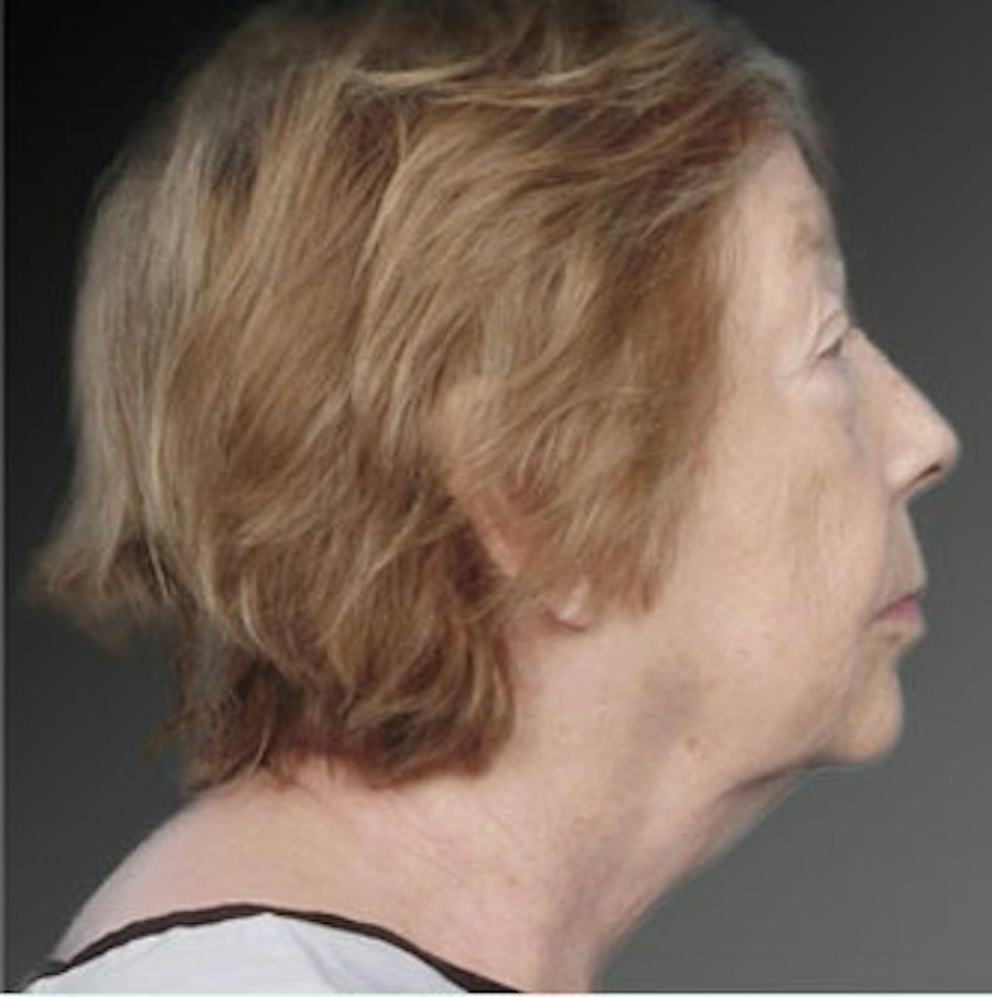 Patient 106009216 | Profile View | Before | Face and Neck Lift — Steven Teitelbaum MD -