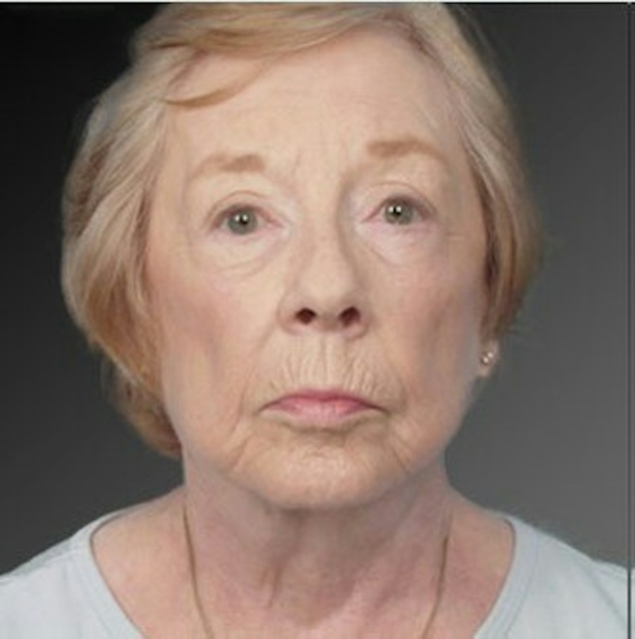 Patient 106009216 | Front View | After | Face and Neck Lift — Steven Teitelbaum MD -