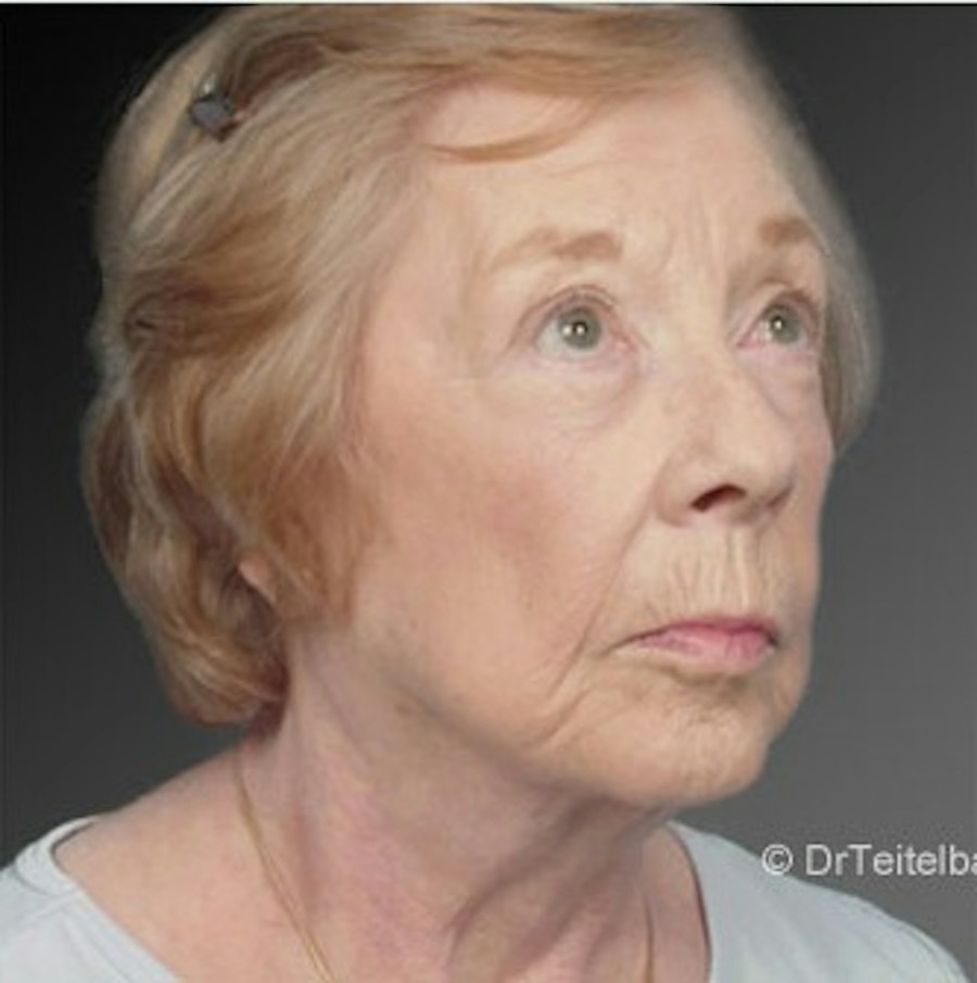 Patient 106009216 | Angle View | After | Face and Neck Lift — Steven Teitelbaum MD -