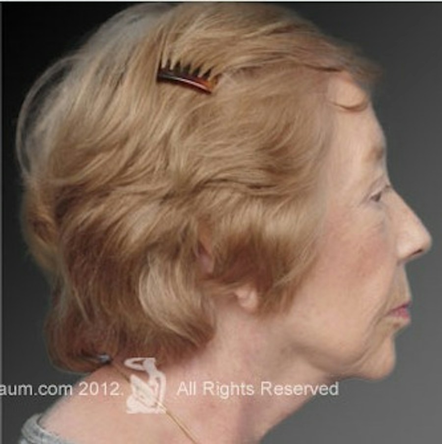 Patient 106009216 | Profile View | After | Face and Neck Lift — Steven Teitelbaum MD -