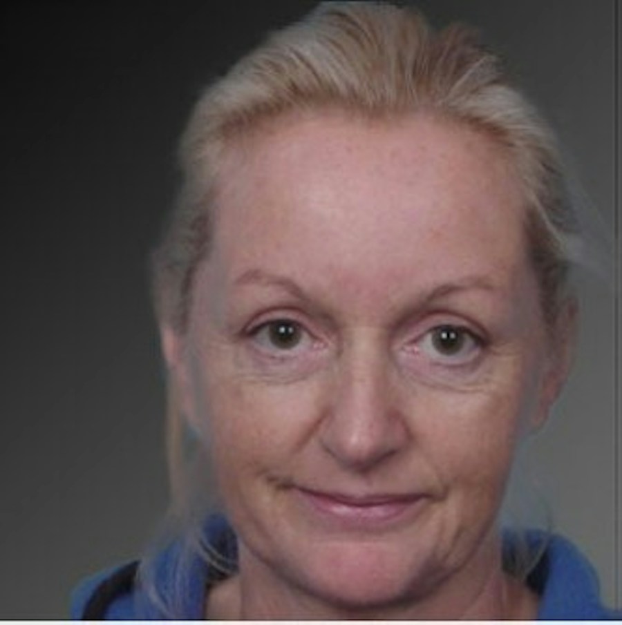 Patient 106009218 | Front View | Before | Face and Neck Lift — Steven Teitelbaum MD -