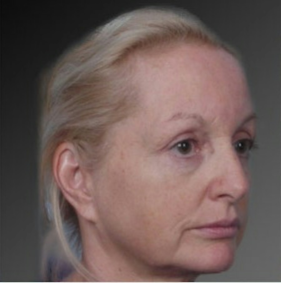 Patient 106009218 | Angle View | Before | Face and Neck Lift — Steven Teitelbaum MD -