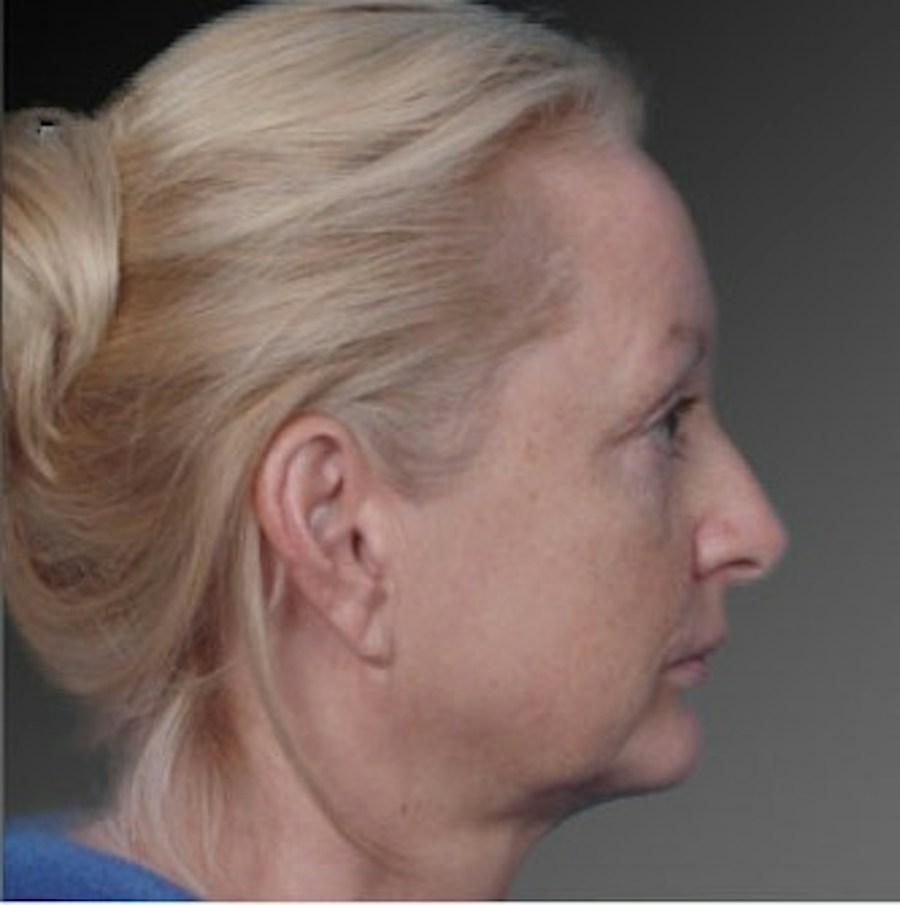 Patient 106009218 | Profile View | Before | Face and Neck Lift — Steven Teitelbaum MD -