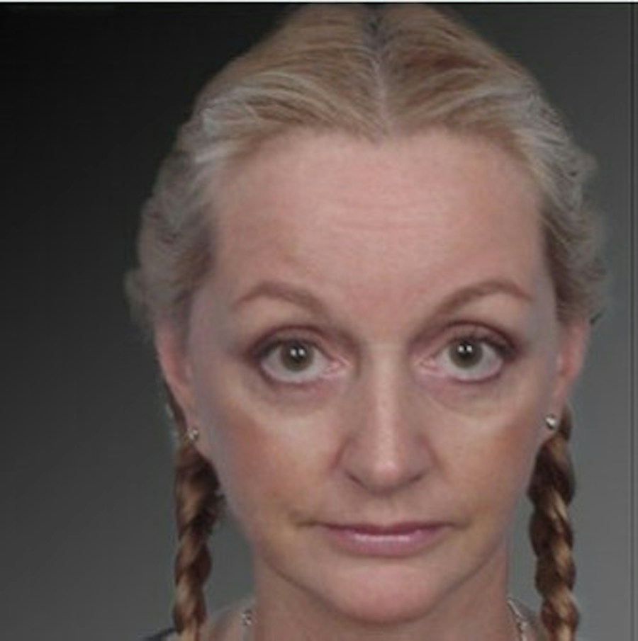 Patient 106009218 | Front View | After | Face and Neck Lift — Steven Teitelbaum MD -