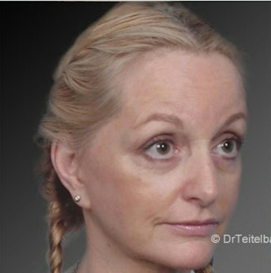 Patient 106009218 | Angle View | After | Face and Neck Lift — Steven Teitelbaum MD -