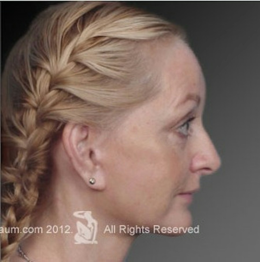 Patient 106009218 | Profile View | After | Face and Neck Lift — Steven Teitelbaum MD -
