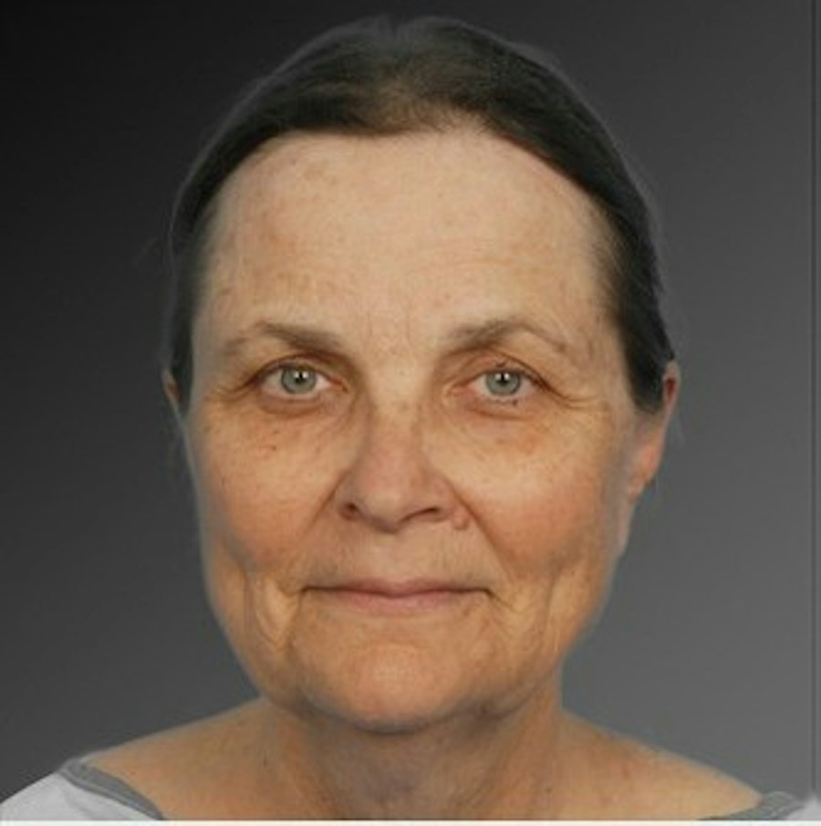 Patient 106009221 | Front View | Before | Face and Neck Lift — Steven Teitelbaum MD -