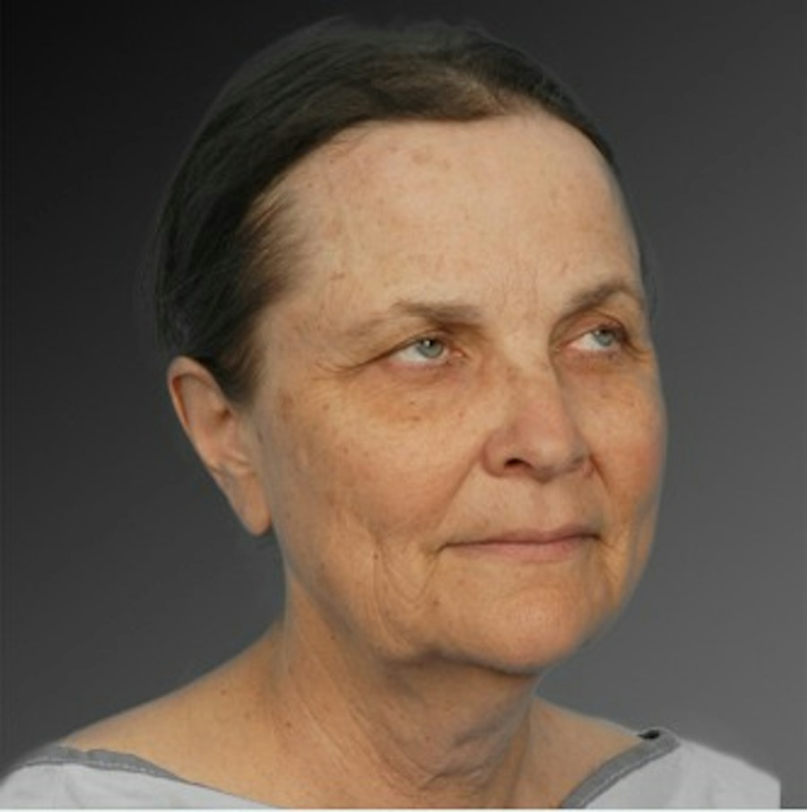 Patient 106009221 | Angle View | Before | Face and Neck Lift — Steven Teitelbaum MD -