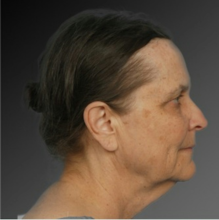 Patient 106009221 | Profile View | Before | Face and Neck Lift — Steven Teitelbaum MD -