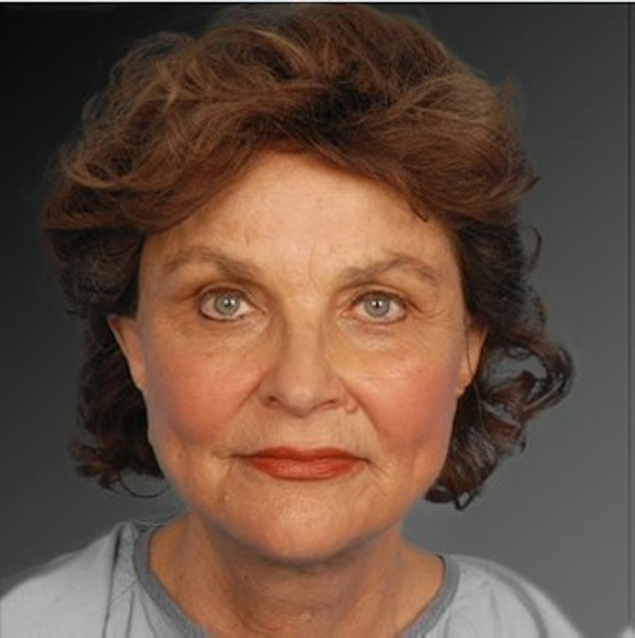 Patient 106009221 | Front View | After | Face and Neck Lift — Steven Teitelbaum MD -