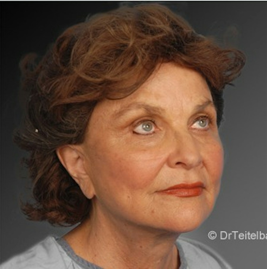 Patient 106009221 | Angle View | After | Face and Neck Lift — Steven Teitelbaum MD -