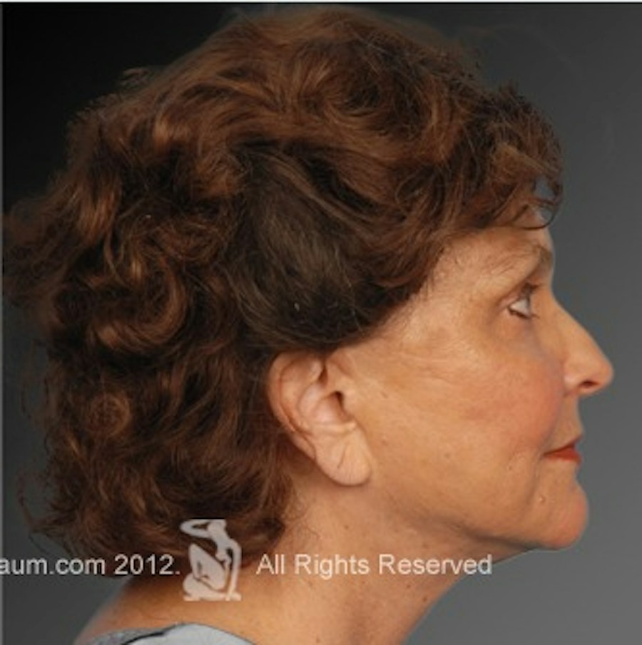 Patient 106009221 | Profile View | After | Face and Neck Lift — Steven Teitelbaum MD -