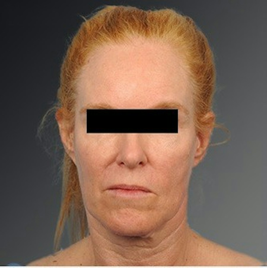 Patient 106009205 | Front View | Before | Face and Neck Lift — Steven Teitelbaum MD -