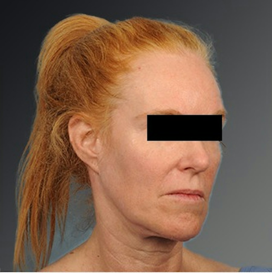 Patient 106009205 | Angle View | Before | Face and Neck Lift — Steven Teitelbaum MD -