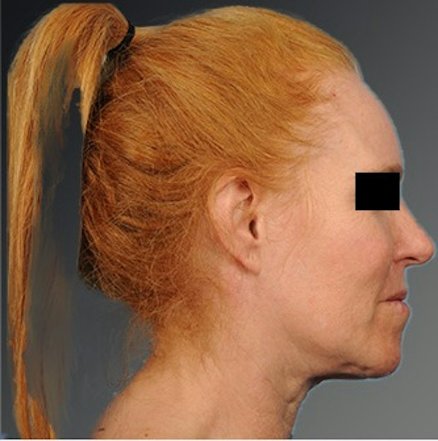 Patient 106009205 | Profile View | Before | Face and Neck Lift — Steven Teitelbaum MD -