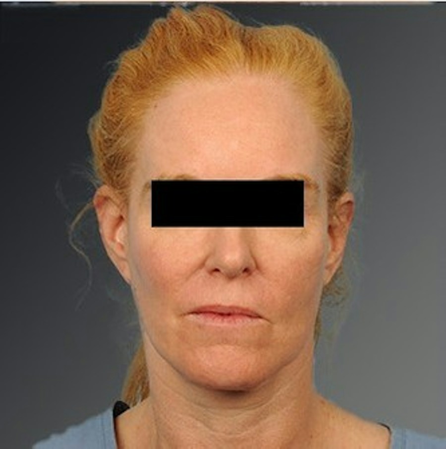 Patient 106009205 | Front View | After | Face and Neck Lift — Steven Teitelbaum MD -
