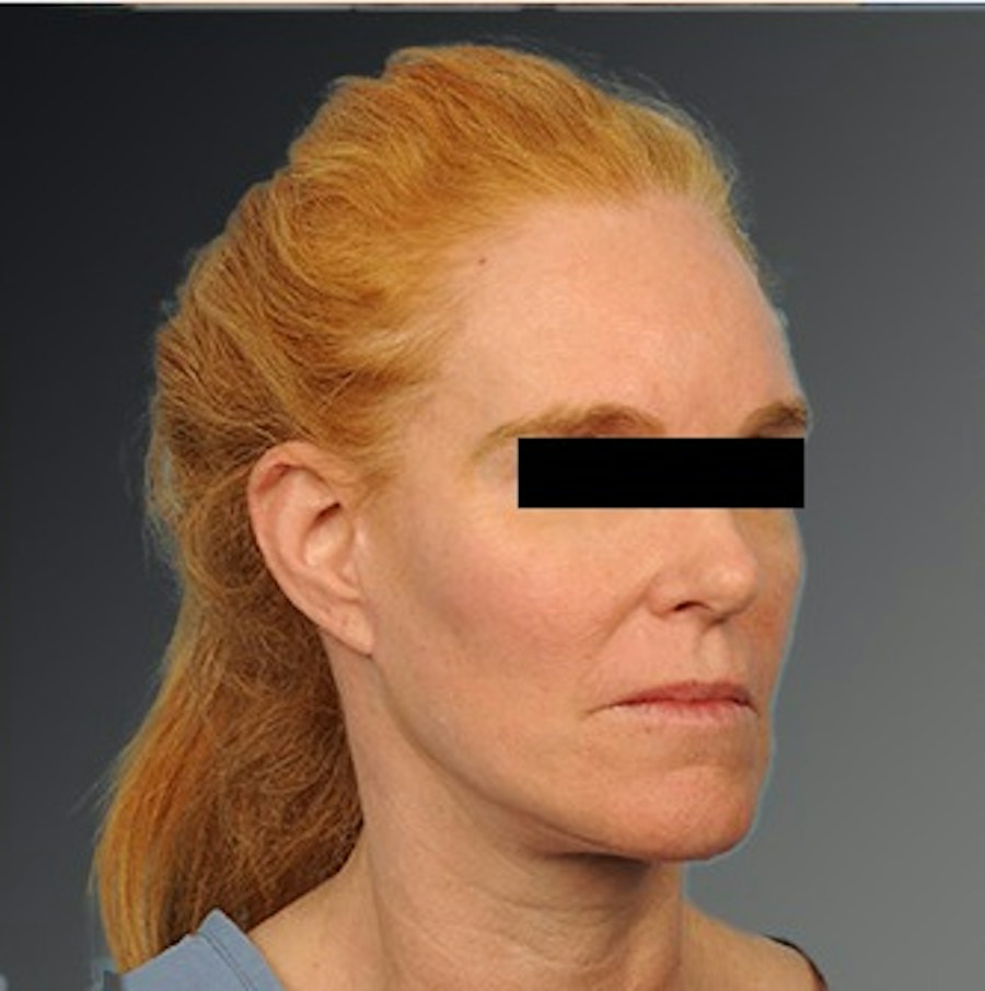 Patient 106009205 | Angle View | After | Face and Neck Lift — Steven Teitelbaum MD -