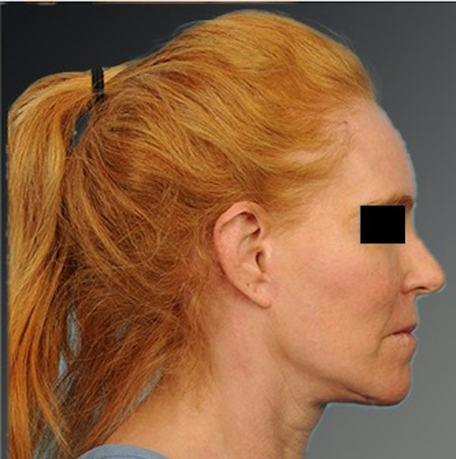 Patient 106009205 | Profile View | After | Face and Neck Lift — Steven Teitelbaum MD -