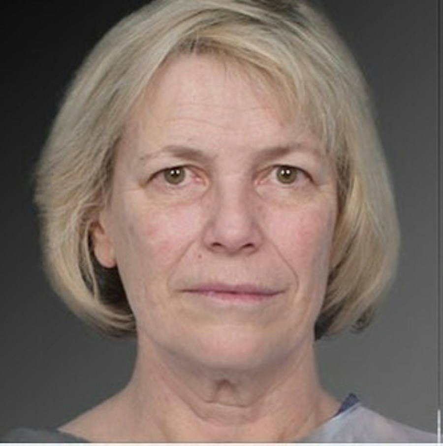 Patient 106009222 | Front View | Before | Face and Neck Lift — Steven Teitelbaum MD -