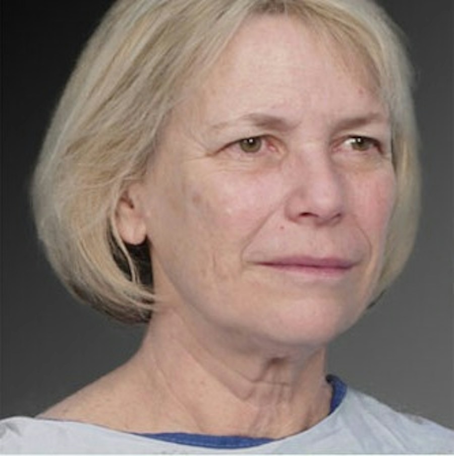Patient 106009222 | Angle View | Before | Face and Neck Lift — Steven Teitelbaum MD -