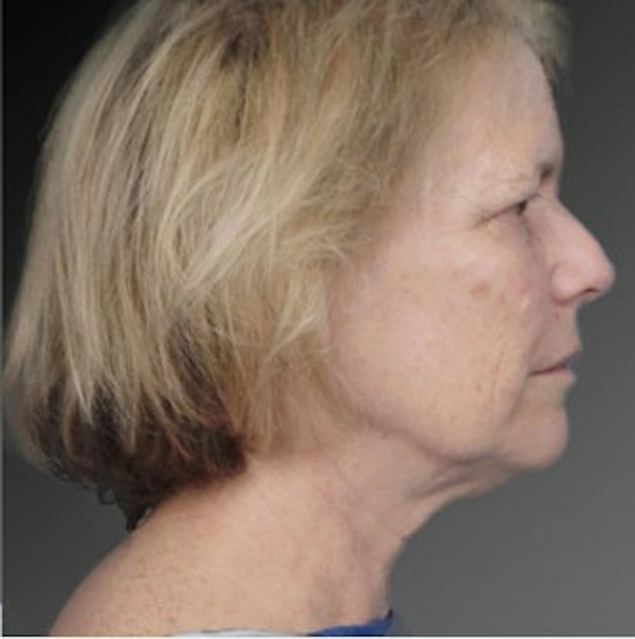 Patient 106009222 | Profile View | Before | Face and Neck Lift — Steven Teitelbaum MD -