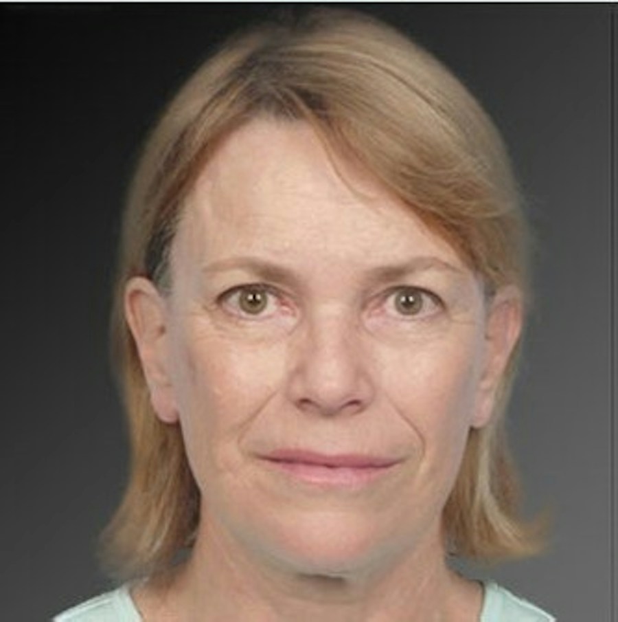 Patient 106009222 | Front View | After | Face and Neck Lift — Steven Teitelbaum MD -