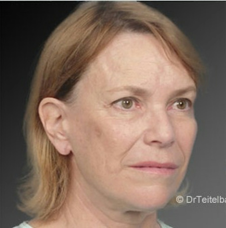 Patient 106009222 | Angle View | After | Face and Neck Lift — Steven Teitelbaum MD -