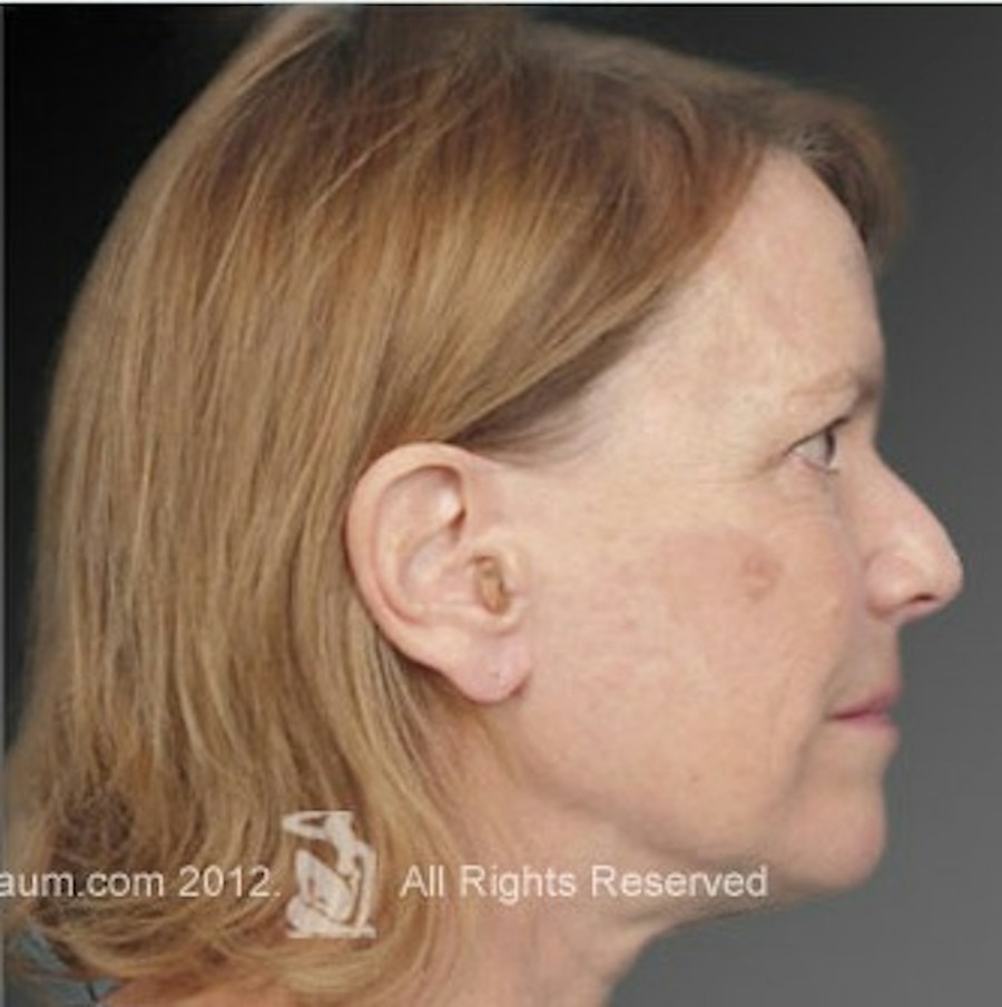 Patient 106009222 | Profile View | After | Face and Neck Lift — Steven Teitelbaum MD -
