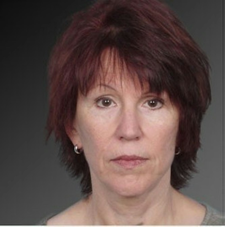 Patient 106009223 | Front View | Before | Face and Neck Lift — Steven Teitelbaum MD -