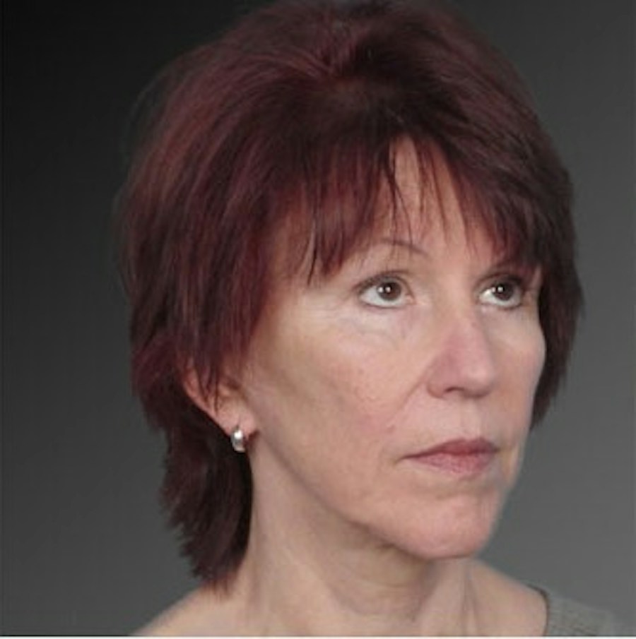 Patient 106009223 | Angle View | Before | Face and Neck Lift — Steven Teitelbaum MD -
