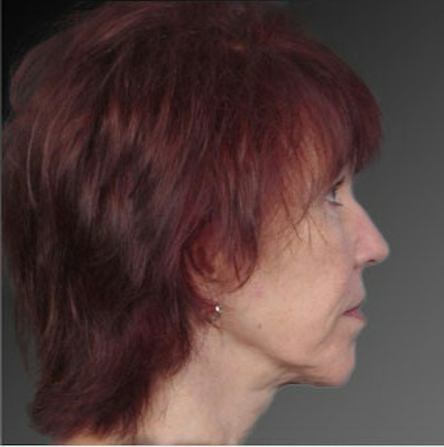 Patient 106009223 | Profile View | Before | Face and Neck Lift — Steven Teitelbaum MD -