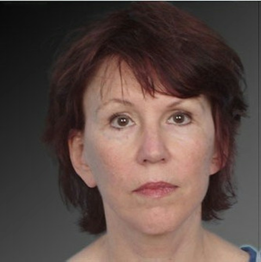 Patient 106009223 | Front View | After | Face and Neck Lift — Steven Teitelbaum MD -