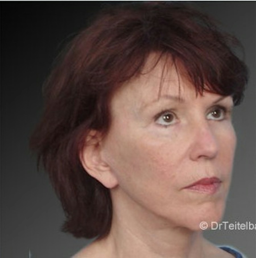 Patient 106009223 | Angle View | After | Face and Neck Lift — Steven Teitelbaum MD -