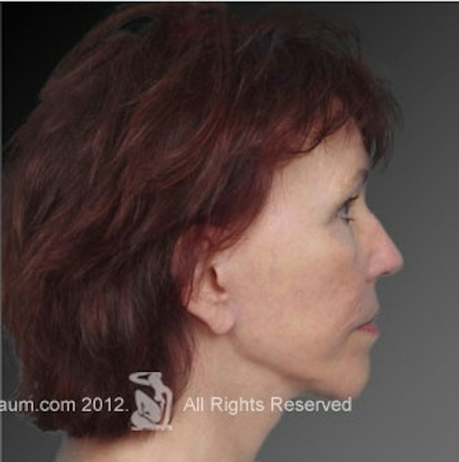 Patient 106009223 | Profile View | After | Face and Neck Lift — Steven Teitelbaum MD -