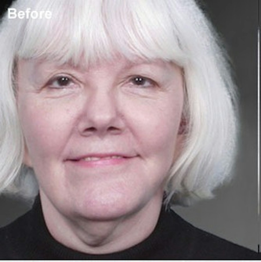 Patient 106009224 | Front View | Before | Face and Neck Lift — Steven Teitelbaum MD -