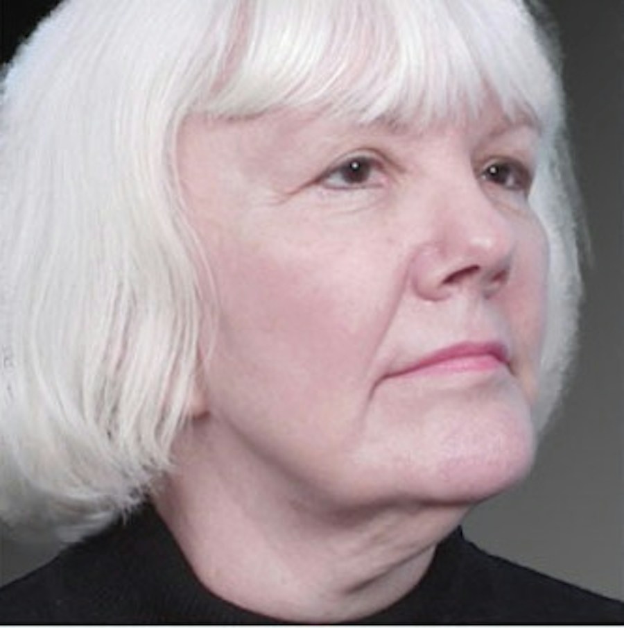 Patient 106009224 | Angle View | Before | Face and Neck Lift — Steven Teitelbaum MD -