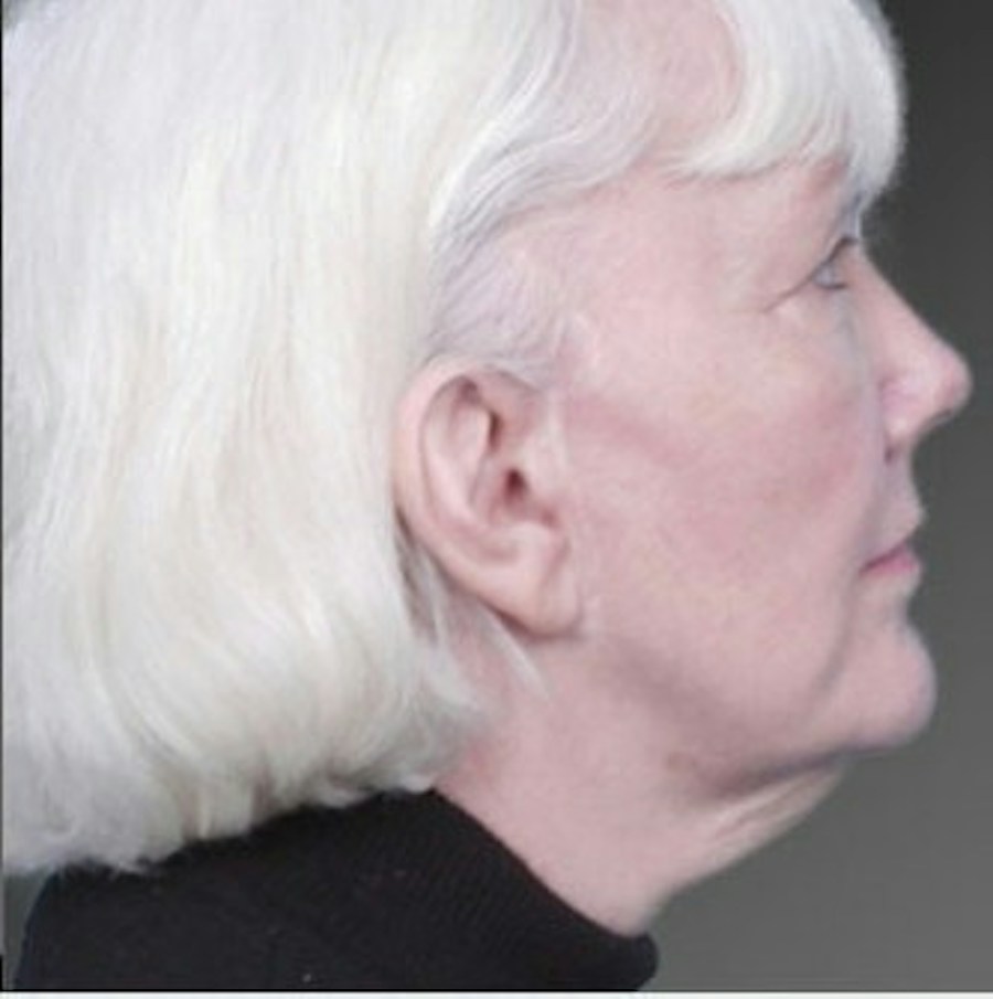 Patient 106009224 | Profile View | Before | Face and Neck Lift — Steven Teitelbaum MD -
