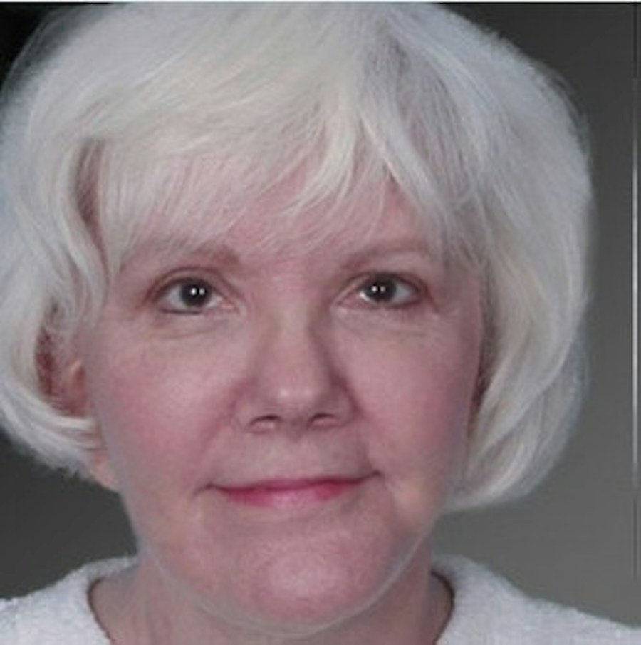 Patient 106009224 | Front View | After | Face and Neck Lift — Steven Teitelbaum MD -