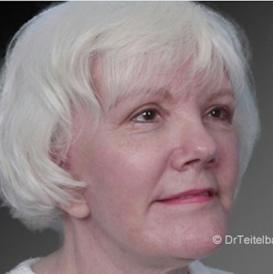 Patient 106009224 | Angle View | After | Face and Neck Lift — Steven Teitelbaum MD -