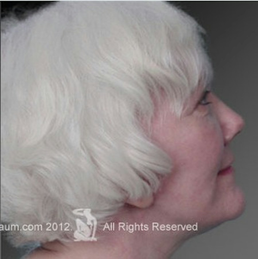 Patient 106009224 | Profile View | After | Face and Neck Lift — Steven Teitelbaum MD -