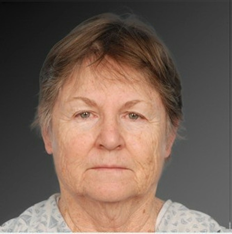 Patient 106009231 | Front View | Before | Face and Neck Lift — Steven Teitelbaum MD -