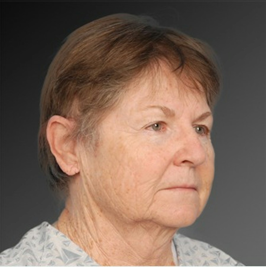 Patient 106009231 | Angle View | Before | Face and Neck Lift — Steven Teitelbaum MD -