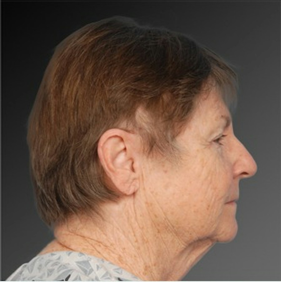 Patient 106009231 | Profile View | Before | Face and Neck Lift — Steven Teitelbaum MD -
