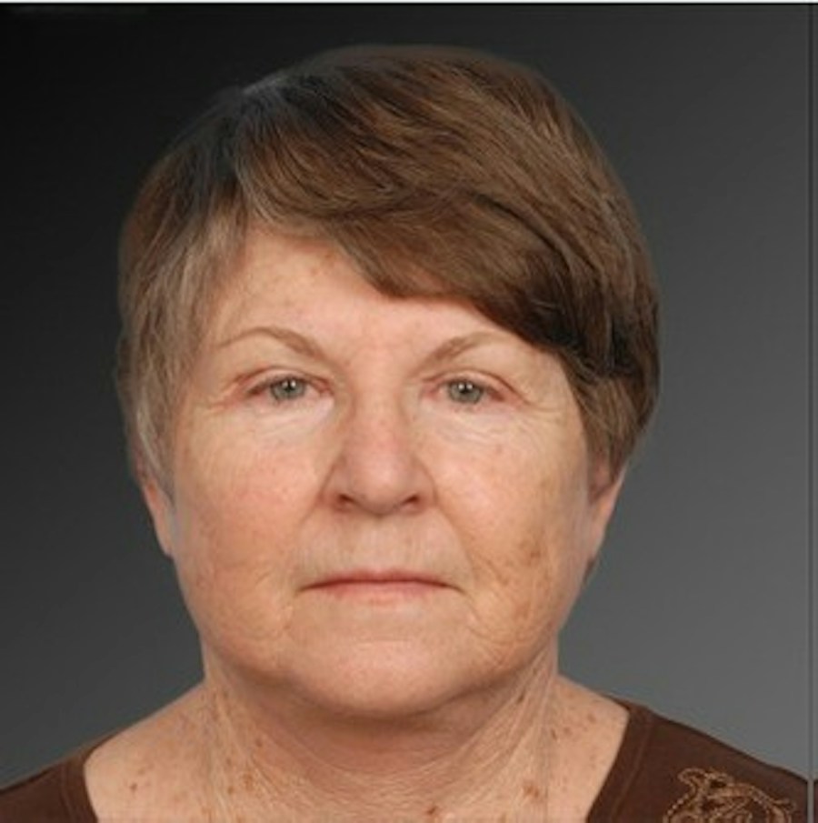 Patient 106009231 | Front View | After | Face and Neck Lift — Steven Teitelbaum MD -