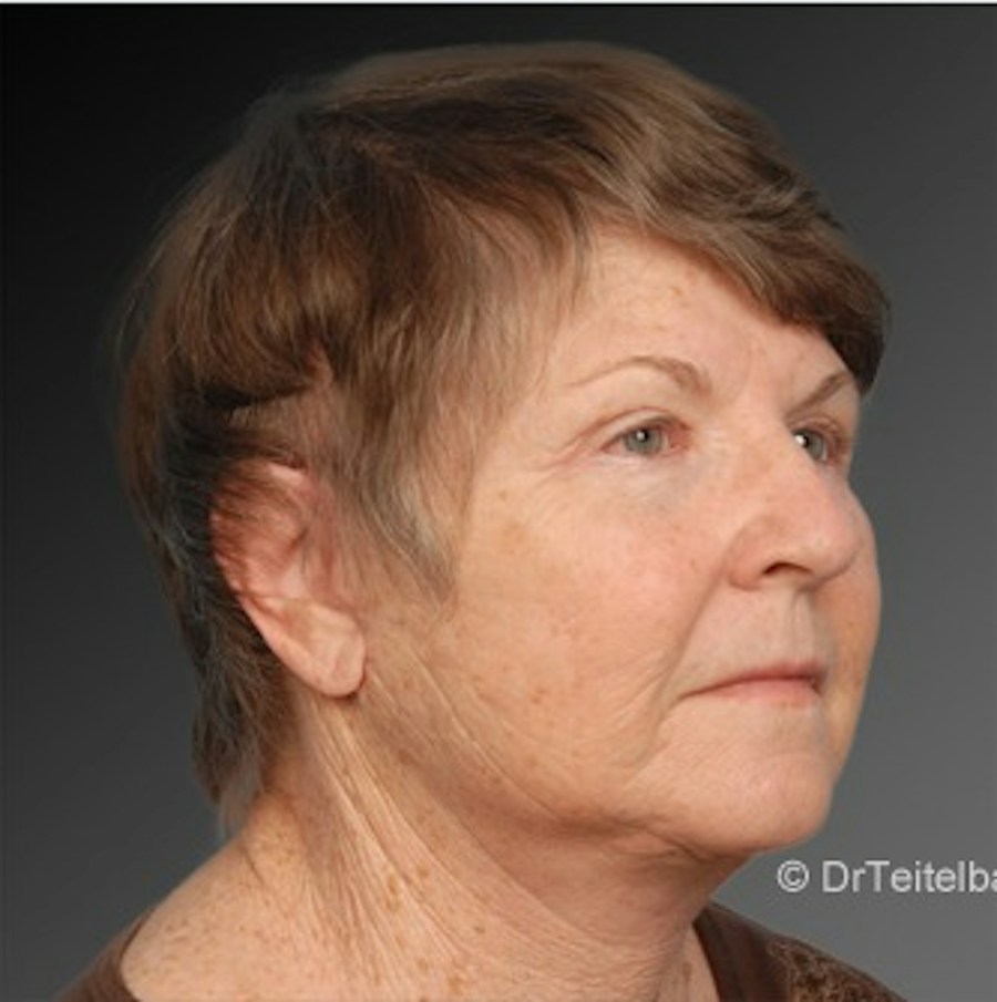 Patient 106009231 | Angle View | After | Face and Neck Lift — Steven Teitelbaum MD -