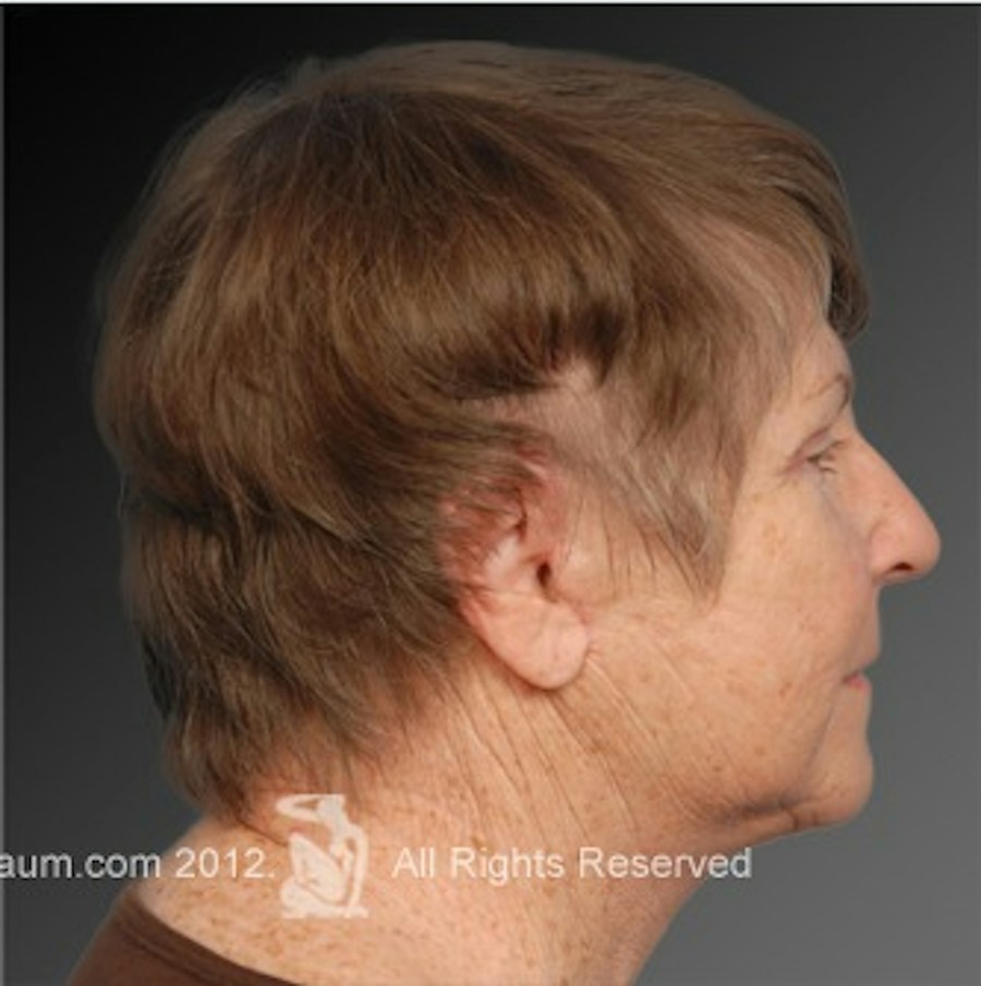 Patient 106009231 | Profile View | After | Face and Neck Lift — Steven Teitelbaum MD -
